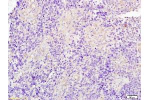 Formalin-fixed and paraffin embedded human glioma tissue labeled with Anti-JUP/Cateninma γ Polyclonal Antibody, Unconjugated at 1:200 followed by conjugation to the secondary antibody and DAB staining (JUP Antikörper  (AA 601-700))