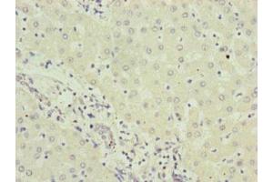 Immunohistochemistry of paraffin-embedded human liver cancer using ABIN7151202 at dilution of 1:100 (RNF5 Antikörper  (AA 1-120))