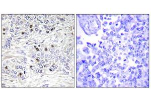 Immunohistochemistry analysis of paraffin-embedded human breast carcinoma tissue, using TEAD2 antibody. (TEAD2 Antikörper  (Internal Region))