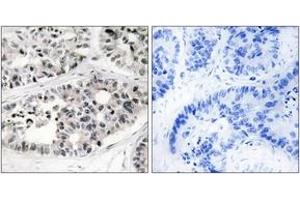 Immunohistochemistry analysis of paraffin-embedded human lung carcinoma tissue, using Collagen VII alpha1 Antibody.