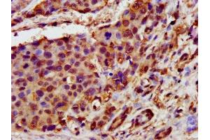 IHC image of ABIN7154521 diluted at 1:400 and staining in paraffin-embedded human pancreatic cancer performed on a Leica BondTM system. (GHITM Antikörper  (AA 293-345))