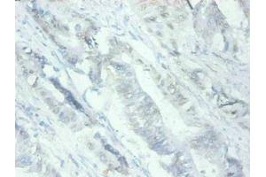 Immunohistochemical of paraffin-embedded human Colon cancer tissues using ABIN7159679 at dilution of 1:200 (MFGE8 Antikörper)