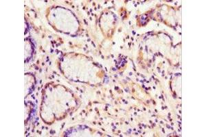 Immunohistochemistry of paraffin-embedded human gastric cancer using ABIN7152221 at dilution of 1:100 (EIF6 Antikörper  (AA 1-245))