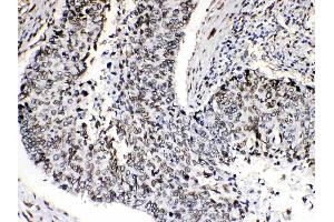 Emerin was detected in paraffin-embedded sections of human lung cancer tissues using rabbit anti- Emerin Antigen Affinity purified polyclonal antibody (Catalog # ) at 1 µg/mL. (Emerin Antikörper  (N-Term))