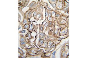 Formalin-fixed and paraffin-embedded human lung carcinoma tissue reacted with HRAS antibody , which was peroxidase-conjugated to the secondary antibody, followed by DAB staining. (HRAS Antikörper  (AA 104-128))