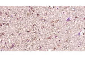 Paraformaldehyde-fixed, paraffin embedded human glioma, Antigen retrieval by boiling in sodium citrate buffer (pH6) for 15min, Block endogenous peroxidase by 3% hydrogen peroxide for 30 minutes, Blocking buffer (normal goat serum) at 37°C for 20min, Antibody incubation with 14-3-3 beta Polyclonal Antibody, Unconjugated  at 1:400 overnight at 4°C, followed by a conjugated secondary and DAB staining. (YWHAB Antikörper  (AA 51-150))