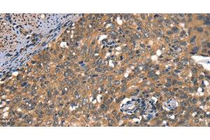 Immunohistochemistry of paraffin-embedded Human cervical cancer using DAAM1 Polyclonal Antibody at dilution of 1:50 (DAAM1 Antikörper)
