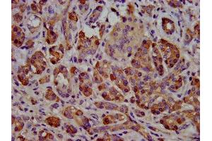 IHC image of ABIN7145595 diluted at 1:500 and staining in paraffin-embedded human pancreatic cancer performed on a Leica BondTM system. (Cholesterol Esterase Antikörper  (AA 661-753))
