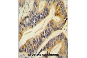 SLC16A11 Antibody (N-term) (ABIN654868 and ABIN2844526) immunohistochemistry analysis in formalin fixed and paraffin embedded human prostate carcinoma followed by peroxidase conjugation of the secondary antibody and DAB staining.
