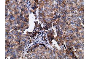 Immunohistochemical staining of paraffin-embedded Human colon tissue using anti-KHK mouse monoclonal antibody. (Ketohexokinase Antikörper)