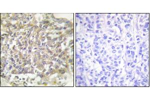 Immunohistochemical analysis of paraffin-embedded human breast carcinoma tissue using Shc (Ab-349) antibody. (SHC1 Antikörper)