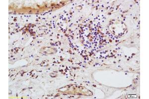Formalin-fixed and paraffin embedded human bladder carcinoma labeled with Anti-MMRN1/ECM Polyclonal Antibody, Unconjugated (ABIN1385517) at 1:200 followed by conjugation to the secondary antibody and DAB staining