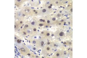 Immunohistochemistry of paraffin-embedded human liver cancer using CSNK2A2 antibody at dilution of 1:100 (400x lens).