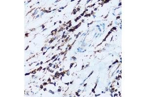 Immunohistochemistry of paraffin-embedded human breast cancer using SPN antibody.