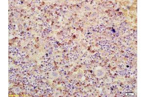Formalin-fixed and paraffin embedded human colon cancer labeled with Anti-ATF3 Polyclonal Antibody, Unconjugated (ABIN669561) at 1:200 followed by conjugation to the secondary antibody and DAB staining (ATF3 Antikörper  (AA 51-150))