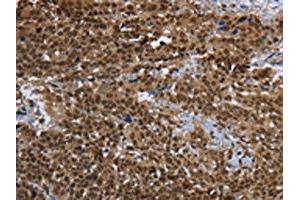 The image on the left is immunohistochemistry of paraffin-embedded Human cervical cancer tissue using ABIN7191991(PRDM2 Antibody) at dilution 1/25, on the right is treated with synthetic peptide. (PRDM2 Antikörper)