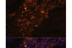 Immunofluorescence analysis of Human lung cancer cells using KRT7 Polyclonal Antibody at dilution of 1:100. (Cytokeratin 7 Antikörper)
