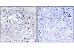Immunohistochemistry analysis of paraffin-embedded human liver carcinoma, using HNF4 alpha (Phospho-Ser313) Antibody. (HNF4A Antikörper  (pSer313))
