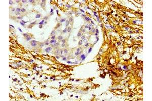 Immunohistochemistry of paraffin-embedded human breast cancer using ABIN7145679 at dilution of 1:100 (BMP1 Antikörper  (AA 317-424))