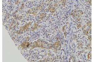 ABIN6279230 at 1/100 staining Human lung cancer tissue by IHC-P. (CALML5 Antikörper  (Internal Region))