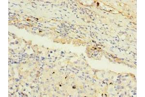 Immunohistochemistry of paraffin-embedded human lung cancer using ABIN7159277 at dilution of 1:100 (MAGEA9 Antikörper  (AA 1-315))