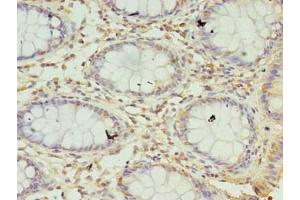 Immunohistochemistry of paraffin-embedded human colon cancer using ABIN7169603 at dilution of 1:100 (SEC11A Antikörper  (Catalytic Subunit))