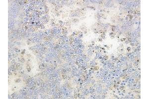 ABIN6262427 and ABIN6268846 at 1/100 staining human melanoma by IHC-P. (TANK Antikörper  (Internal Region))