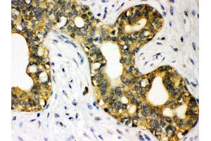 Anti- STAT1 Picoband antibody, IHC(P) IHC(P): Human Mammary Cancer Tissue (STAT1 Antikörper  (N-Term))