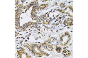 Immunohistochemistry of paraffin-embedded human breast cancer using DRD3 Antibody. (DRD3 Antikörper)