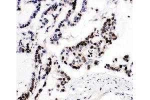 IHC-P: MCM6 antibody testing of human intestinal cancer tissue (MCM6 Antikörper  (Middle Region))