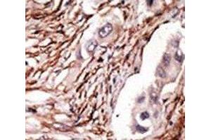 IHC analysis of FFPE human breast carcinoma tissue stained with the NOTCH3 antibody