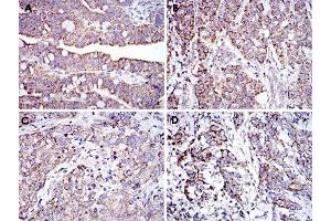 Immunohistochemical analysis of paraffin-embedded human rectum cancer tissue (A), liver cancer tissue (B), lung cancer tissue (C) and stomach cancer tissue (D) using PHB monoclonal antobody, clone 5H7  with DAB staining.