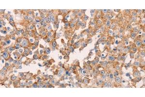 Immunohistochemistry of paraffin-embedded Human breast cancer using GNA11 Polyclonal Antibody at dilution of 1:40 (GNA11 Antikörper)