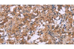 Immunohistochemistry of paraffin-embedded Human thyroid cancer tissue using GNPAT Polyclonal Antibody at dilution 1:40 (GNPAT Antikörper)
