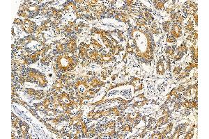 ABIN7095645 and ABIN7099707 at 1/100 staining human colorectal cancer by IHC-P. (KCTD18 Antikörper)