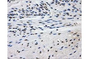 Immunohistochemical staining of paraffin-embedded Carcinoma of liver tissue using anti-L1CAMmouse monoclonal antibody.