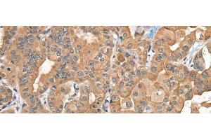 Immunohistochemistry of paraffin-embedded Human thyroid cancer tissue using BCAN Polyclonal Antibody at dilution of 1:35(x200) (BCAN Antikörper)