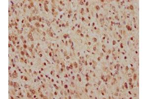 IHC image of ABIN7127412 diluted at 1:165 and staining in paraffin-embedded human glioma cancer performed on a Leica BondTM system. (Rekombinanter CDC25C Antikörper)