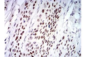 Immunohistochemical analysis of paraffin-embedded esophageal cancer tissues using UFD1L mouse mAb with DAB staining. (UFD1L Antikörper  (AA 208-307))
