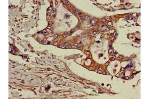 Immunohistochemistry of paraffin-embedded human pancreatic cancer using ABIN7143469 at dilution of 1:100 (GGA3 Antikörper  (AA 342-503))