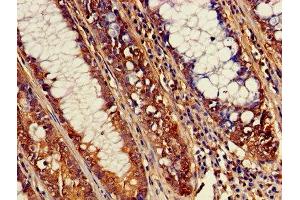 Immunohistochemistry of paraffin-embedded human colon cancer using ABIN7170052 at dilution of 1:100
