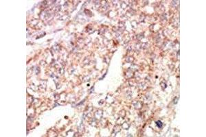 IHC analysis of FFPE human hepatocarcinoma tissue stained with the EphA1 antibody (EPHA1 Antikörper  (AA 29-60))