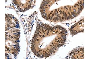 The image on the left is immunohistochemistry of paraffin-embedded Human colon cancer tissue using ABIN7190308(CMTM3 Antibody) at dilution 1/20, on the right is treated with synthetic peptide. (CMTM3 Antikörper)
