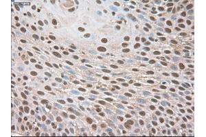 Immunohistochemical staining of paraffin-embedded Adenocarcinoma of breast using anti-Trim33 (ABIN2452535) mouse monoclonal antibody. (TRIM33 Antikörper  (AA 887-1046))
