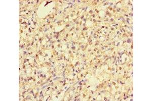 Immunohistochemistry of paraffin-embedded human gastric cancer using ABIN7154592 at dilution of 1:100