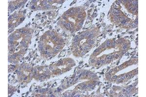 IHC-P Image Immunohistochemical analysis of paraffin-embedded human colon carcinoma, using C14orf94, antibody at 1:500 dilution. (C14orf94 Antikörper)