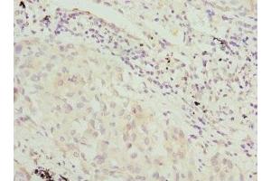 Immunohistochemistry of paraffin-embedded human lung cancer using ABIN7169217 at dilution of 1:100 (VRK1 Antikörper  (AA 257-396))