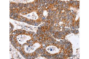 Immunohistochemistry of Human ovarian cancer using MAP2K5 Polyclonal Antibody at dilution of 1:40 (MAP2K5 Antikörper)