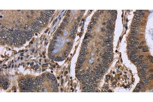 Immunohistochemistry of paraffin-embedded Human colon cancer using DCP1A Polyclonal Antibody at dilution of 1:50 (DCP1A Antikörper)