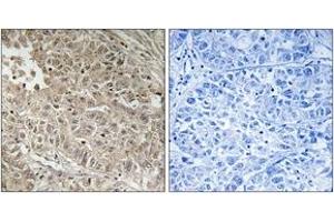 Immunohistochemistry analysis of paraffin-embedded human liver carcinoma tissue, using ABCC13 Antibody. (ABCC13 Antikörper  (AA 56-105))
